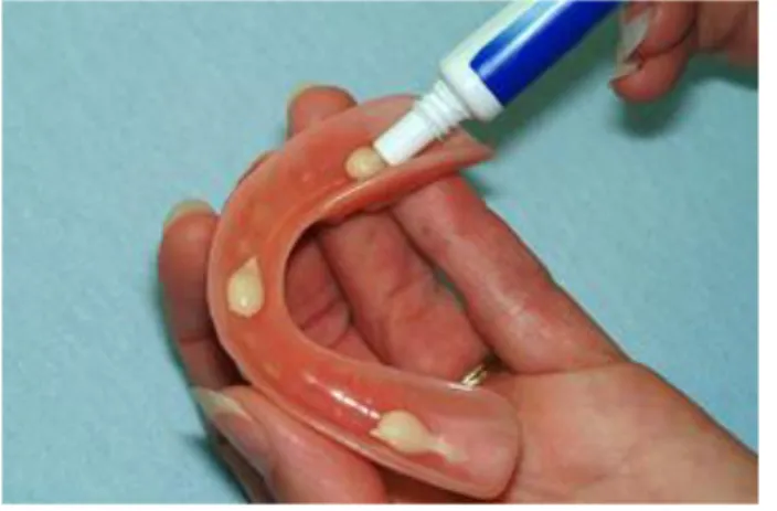 Figure 1 : Application de l’adhésif dentaire à la prothèse mandibulaire 