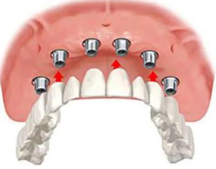 Figure 8: Bridge fixe implanto-porté sur 6 implants 