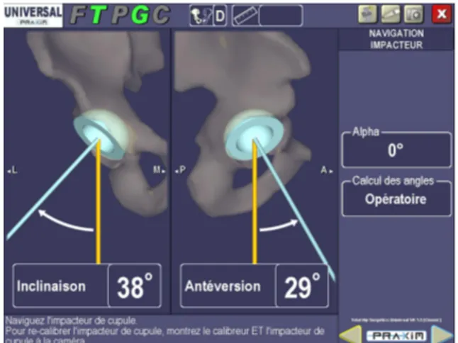 Figure   3   :   Capture   d’écran   de   la   station    Surgetics ® :   modification   de   la   longueur    du   membre   et   de   l’offset   de   la   hanche