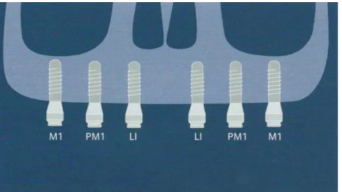 Figure 7 : Quatre à six implants séparés avec attachement de type Locator®, (d’après le Guide  de traitement de l’ITI, volume 4, Quintessence Pub Co)