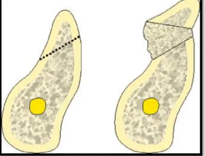 Figure 4 : Mobilisation du fragment d'os crestal et du greffon osseux interpositif.  