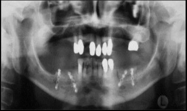 Figure 5. Radiographie panoramique postopératoire montrant la greffe osseuse  interposée aux deux sites de la mandibule