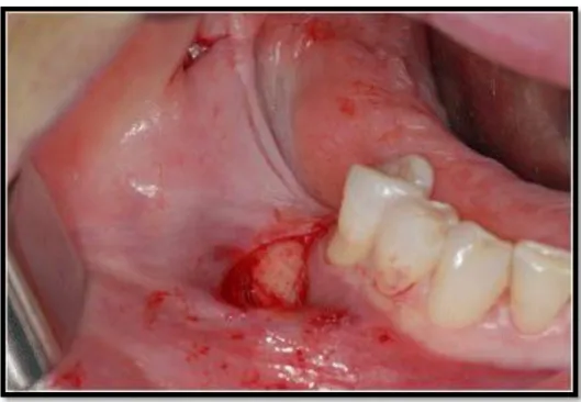 Figure 9 : les deux incisions verticales 