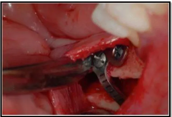 Figure 11 : Segment mobilisé déplacé dans la position souhaitée et fixé  à l'aide d'une plaque et de vis 