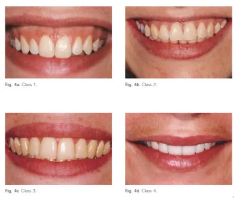 Figure 8 : Les différents types de sourire selon Liébart (17) 
