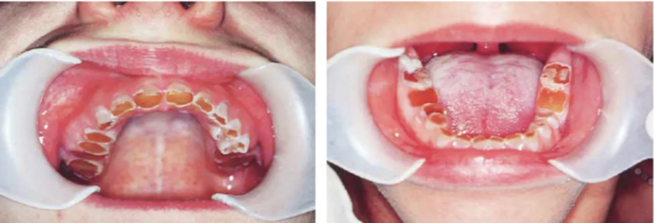 Figure 10 : Vue exo-buccale d'un jeune patient atteint de dentinogenèse imparfaite  héréditaire (34) 
