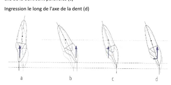 Figure 2 : Différents types d'ingression en fonction du point d'application de la force (24) 