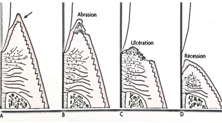 Figure 10. Pathogénèse de la récession gingivale liée au traumatisme» (13).