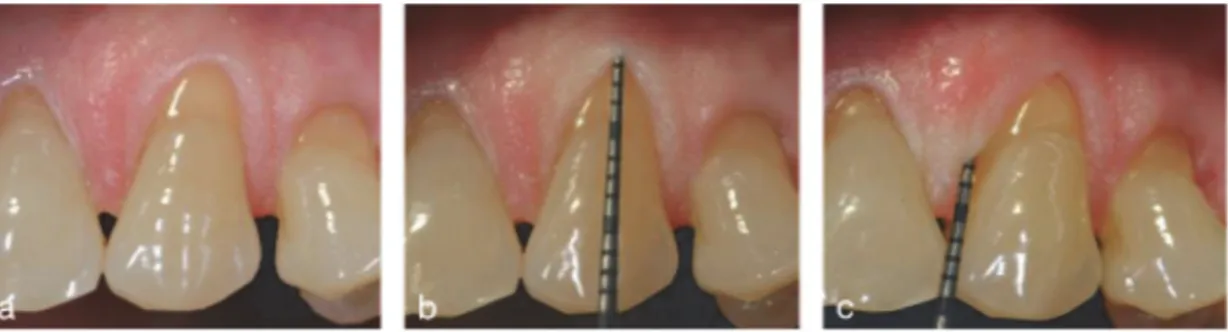 Figure 21 . (a) Récession gingivale vestibulaire sur 23, (b) le niveau de perte d’attache en vestibulaire étant de 4mm, (c) et le  niveau interproximale de perte d’attache clinique étant de 3 mm, le diagnostic final est &#34;récession de type 2&#34;. (30) 