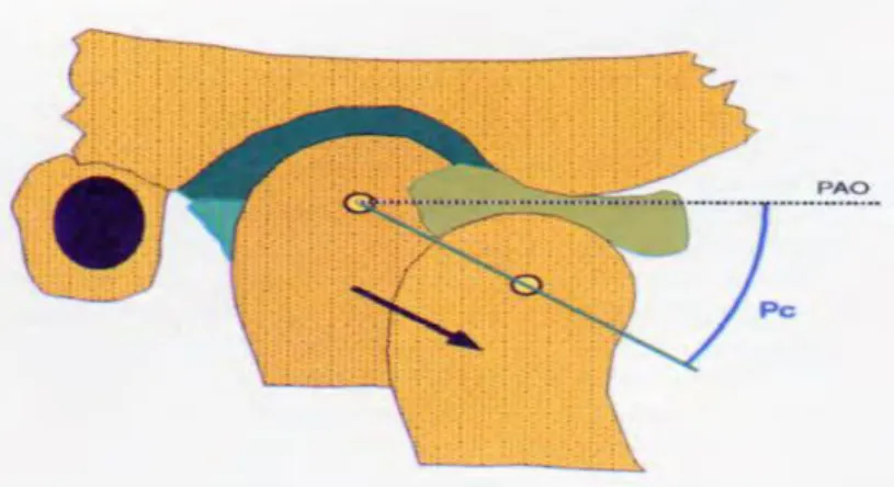 Figure 5 : Pente condylienne [48] 