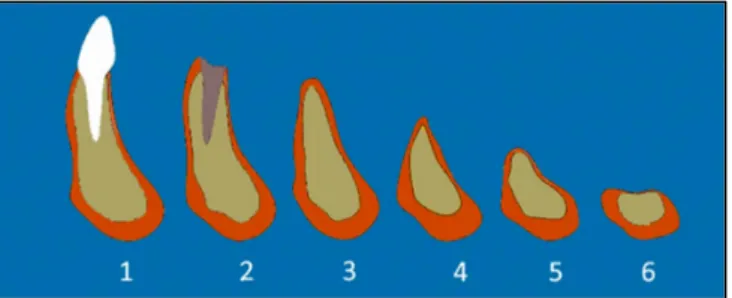Figure 3 : Les stades de la résorption osseuse selon Cawood et Howell (21) 