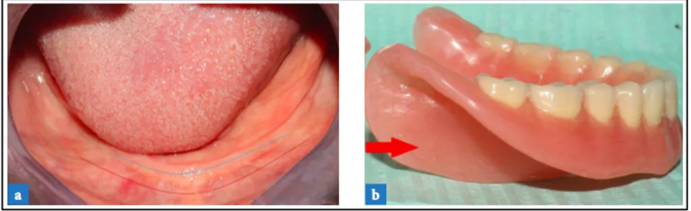 Figure 6a : Crête mandibulaire résorbée défavorable à la stabilité  Figure 6b : Utilisation des volets para-linguaux pour majorer la stabilité 