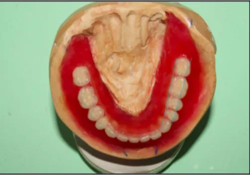 Figure 17 : Montage des dents postérieures en respectant l’aire de Pound (35) 