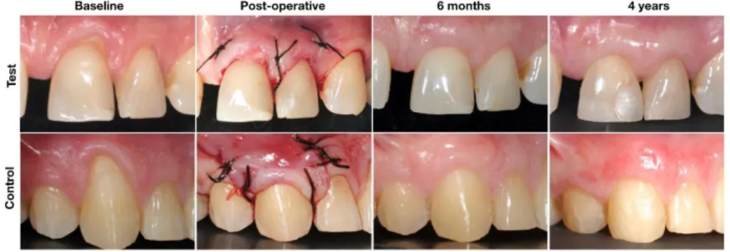 Figure 2. Surgical procedures and follow-up in Test (POT+CTG) and Control (CAF+CTG). 
