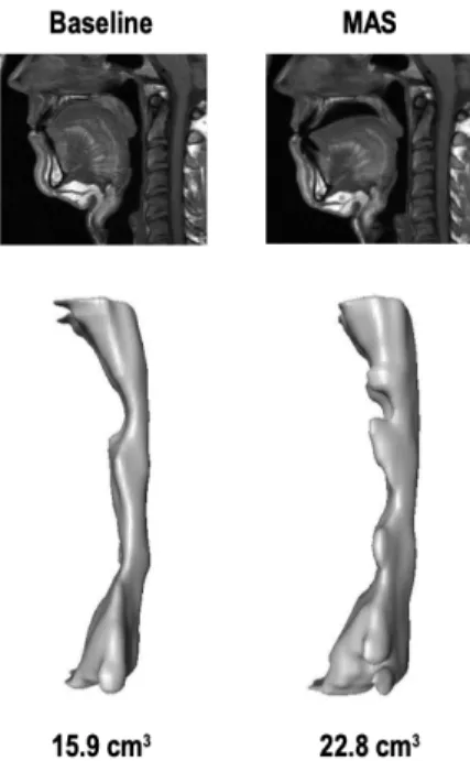 Figure 5 - Reconstruction 3D d'IRM, l'augmentation des VAS par l'OAM à droite par rapport au témoin à gauche (Sutherland  et Coll