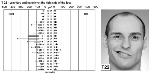 Figure  16 : Répartition du signal EMG lors d'un sourire unilatéral d'après Schumann et al