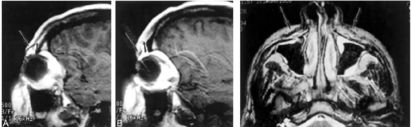 Figure 20. Etude de la différence d’aspect entre le coté sain (A) et le coté paralysé (B) sur une coupe sagittale  pour l’orbiculaire des paupières et pour le releveur de la lèvre supérieure sur une coupe frontale (Kaylie, 2003) 