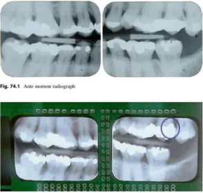 Figure 8: Correspondance des éléments de restaurations dentaires sur radiographies ante-mortem  et post-mortem avec carie distale de 27 traitée, le soin est visible sur la radiographie post-mortem 