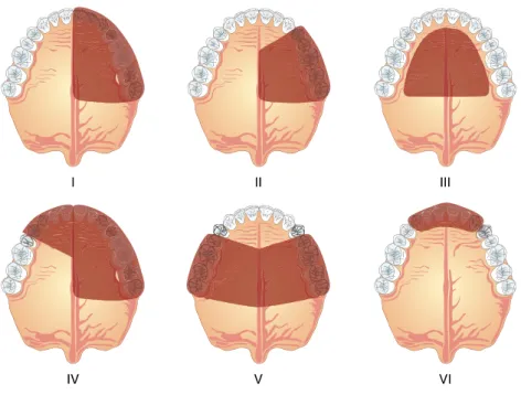 Figure 1 : Classification des pertes de substance maxillo-faciale par Aramany (1978) (8) 