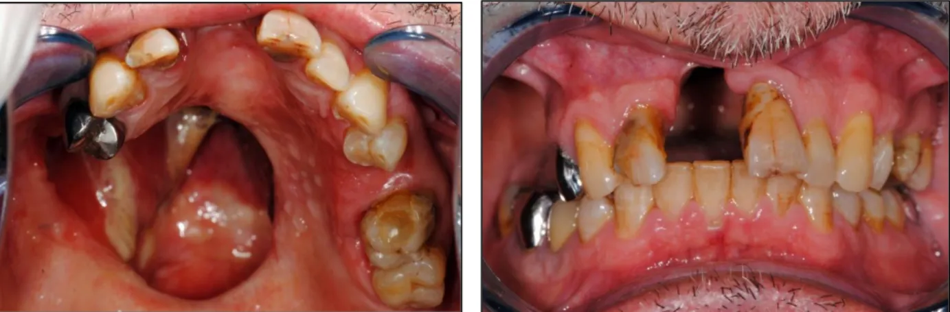 Figure 4 : Photographie intra-buccale du patient en occlusion  par le Dr BOU Christophe 