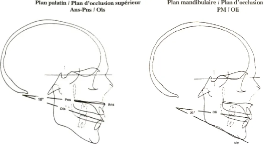 Figure 2 : Angle Plan palatin / Plan d’occlusion supérieur (gauche) ; Plan mandibulaire/ Plan d’occlusion inférieur  (droite).(5) 