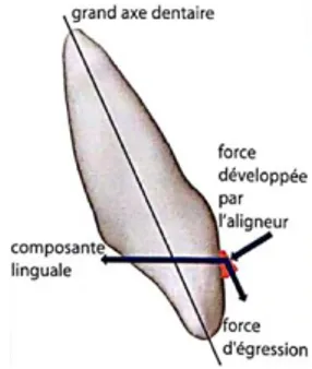 Figure 9 : Force applicable sur une attache collée sur la couronne dentaire (14).