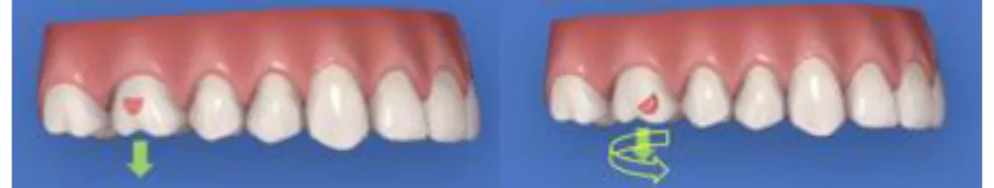 Figure 13 : Egression d’une molaire avec taquet d’égression optimisé. Source : Académie Invisalign®, 2019
