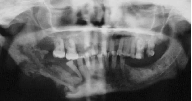 Figure 4 : Radiographie panoramique d’une ORN mandibulaire(30). 