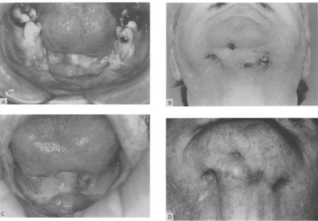 Figure 6 : Photographies de lésions ostéoradionécrotiques avant et après le traitement  par ultrason.(46)