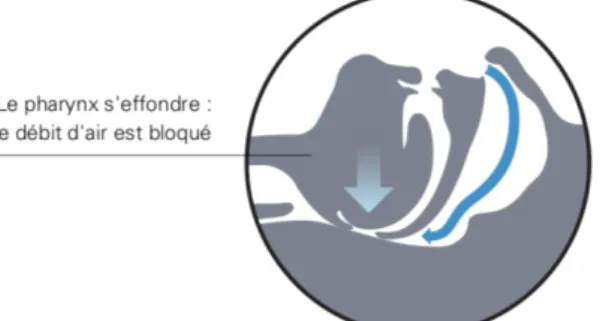 Figure 1 : Collapsus du pharynx au cours d’apnée dans le SAOS issue du Guide Pratique des orthèses Narval 