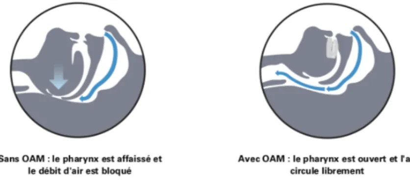 Figure 2 : Schéma de pharynx d’un patient atteint de SAOS sans OAM à gauche et avec OAM à droite ; issu du guide  de port de l’orthèse Narval de chez Resmed  