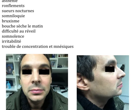 Figure 5 : Photos exobuccales du patient de face et de profil  