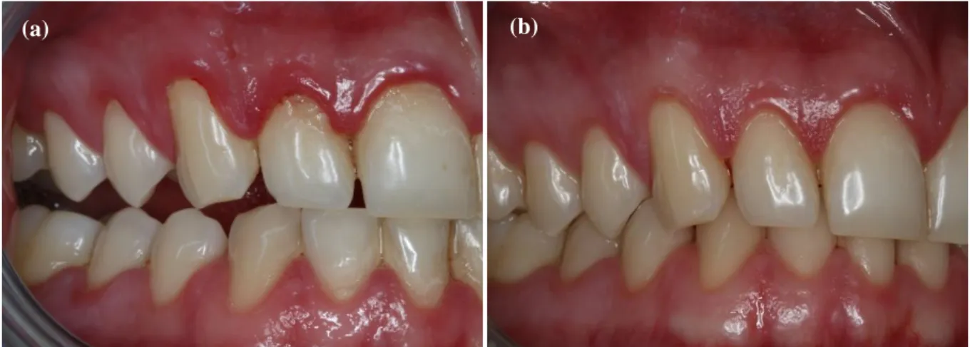 Figure 6 : (a) Gingivite liée à la plaque (selon la classification d’Armitage, AAP, 1999) chez  un  patient  de  24  ans