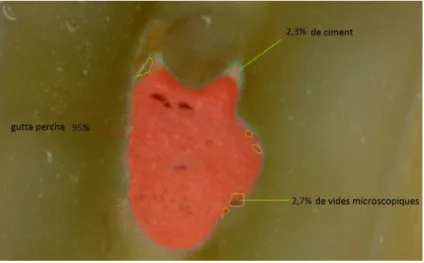 Fig. 8 : Pourcentages des vides microscopiques, de ciment et de gutta-percha sur une coupe  transversale pour la technique combinée partielle avec les instruments en nickel-titane