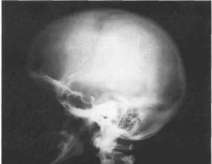 Figure 14 : Radiographie du crâne de la mère affectée présentant une sclérose légère de la  voûte et de la base du crâne caractéristique