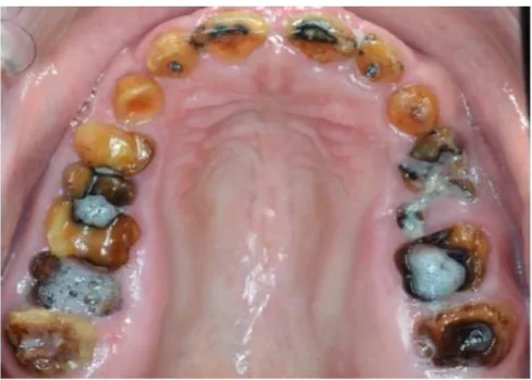 Figure 17 : Vue intra-buccale de l'arcade mandibulaire 