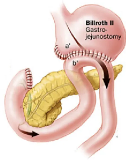 Figure 4. Reconstruction de type Billroth II après gastrectomie partielle 