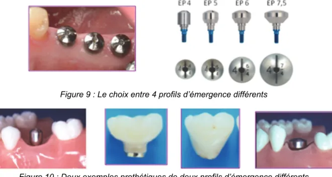 Figure 8 : Information du pilier de cicatrisation 