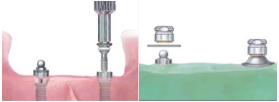 Figure 33 : Pilier Dal-Ro ® I.3.4.4. Comparaison des 3 systèmes 