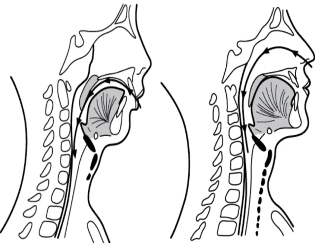 Figure  2 :  Adaptation  linguale  chez  un  respirateur  buccal  à  gauche  par  rapport  à  un  respirateur nasal à droite (14) 