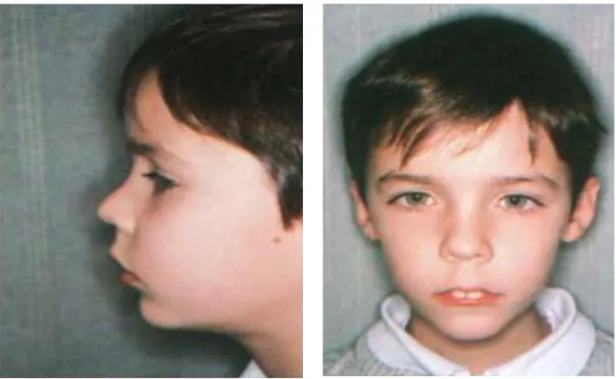 Figure 3 : Photographies de profil et de face d’une enfant respirateur buccal (15) 