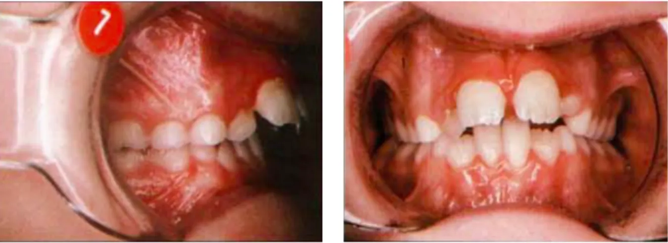 Figure  4 :  Classe  II-1  observée  chez  un  enfant  respirateur  buccal,  associée  à  une  inflammation gingivale  du secteur incisif   (15) 