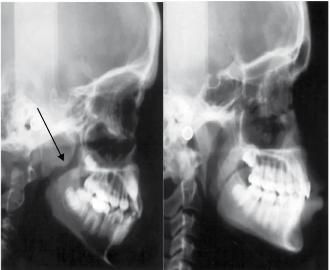 Figure  5 :  Téléradiographie  de  profil  d’un  respirateur  buccal  à  gauche  par  rapport  à  un  respirateur nasal à droite
