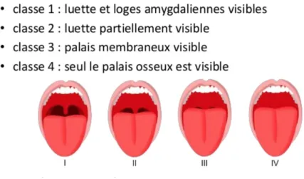 Figure 2  :  Score de Mallampati