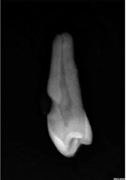 Figure 4: Traitement endodontique d'une dent obturée avec le Mac Spadden 1- Radiographie préopératoire 2- Radiographie 1ère lime à la LT 