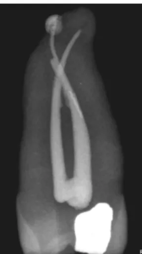 Figure  9:  dent  n°23  contenant  un  morceau  de  Gutta  Condensor®  dans  son  obturation 