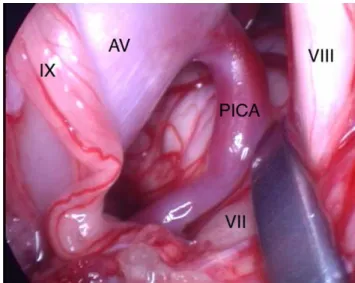 Fig. 1. Angle pontocérébelleux gauche : repérage sous endoscopie d’un conﬂit impliquant le nerf facial (VII) et l’artère cérébelleuse postéro-inférieure (PICA) naissant de l’artère vertébrale (AV)