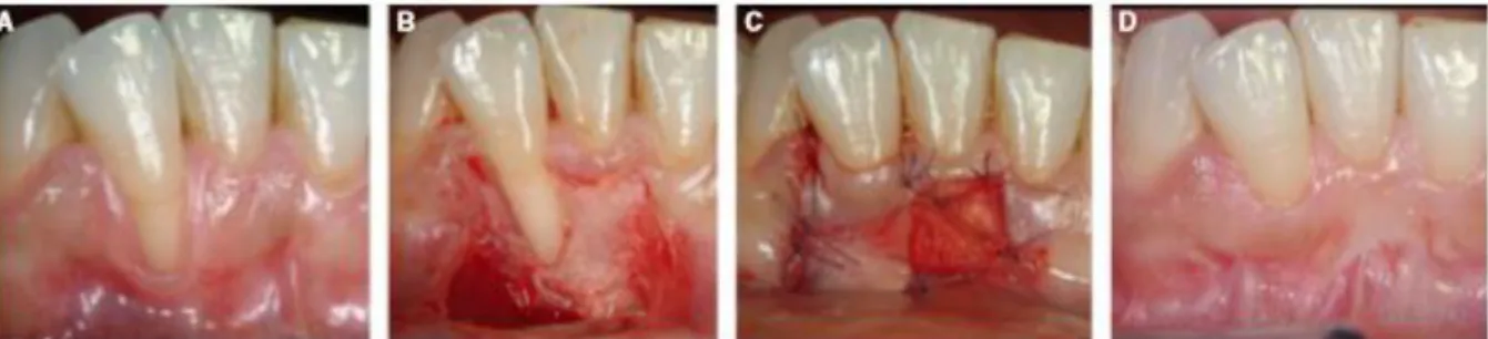Figure 6 : A : Situation initiale 42 B : Réalisation du Lambeau positionné latéralement C :  Réalisation des points de sutures D : Situation à un an post-opératoire(27)