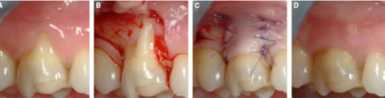 Figure 7 : A : Récession sur la racine mésiale de la 16 B : Réalisation du LPL C : Réalisation des  points de sutures D : Situation à un an post-opératoire (27)