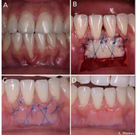 Figure 10 : A : Situation initiale B : Suture de la greffe C : Situation à J+7 D : Situation à J+7  après déposes des points de suture (courtoisie du Dr Moreau) 